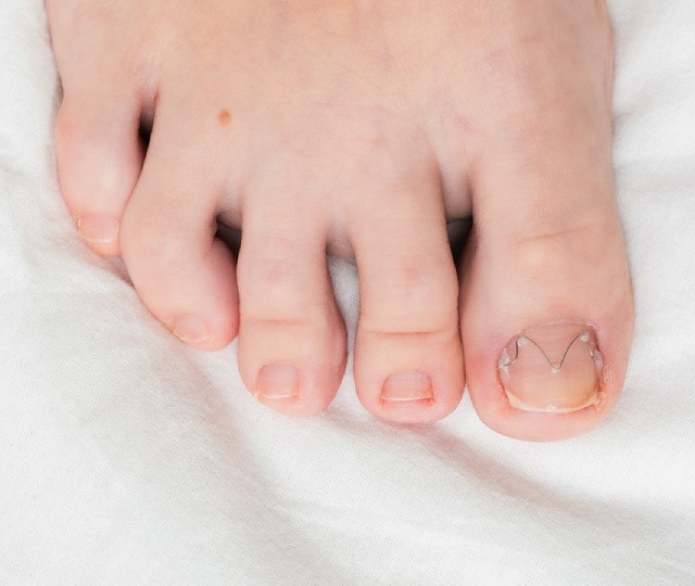Klamry podologiczne stosowane w leczeniu wrastających paznokci